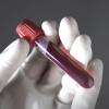 Повышенный гемоглобин в крови – о чем предупреждает организм
