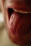 Сыпь на языке: виды и причины поражения
